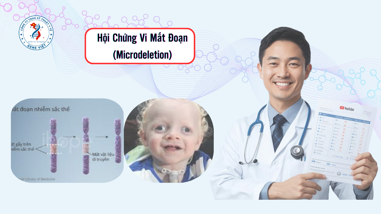 Hội Chứng Vi Mất Đoạn (Microdeletion) Là Gì?