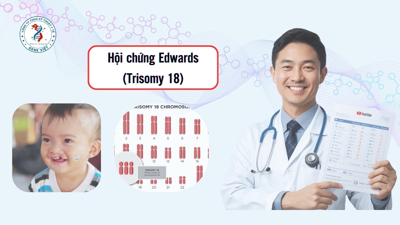 Hội Chứng Edwards (Trisomy 18): Dấu Hiệu, Sàng Lọc & Tiên Lượng