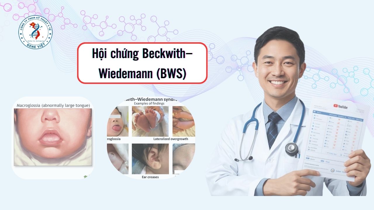 Hội Chứng Beckwith–Wiedemann