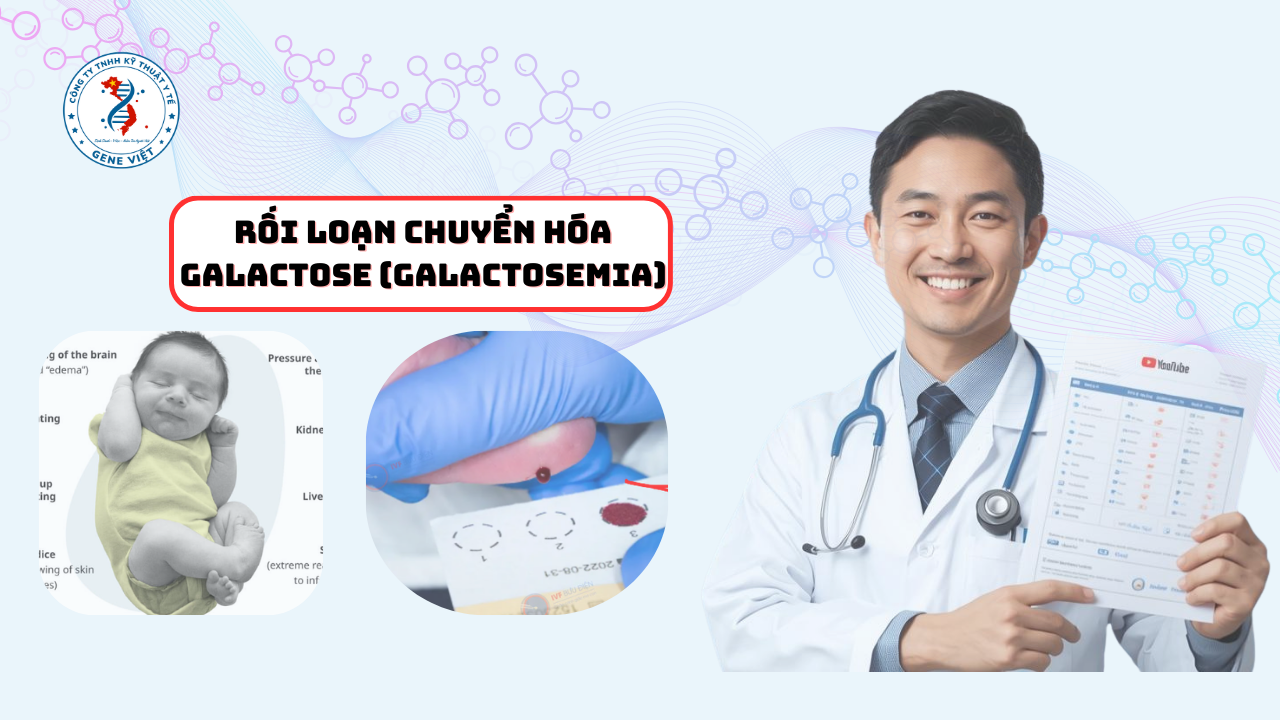 Rối Loạn Chuyển Hóa Galactose: Dấu Hiệu, Chẩn Đoán & Điều Trị