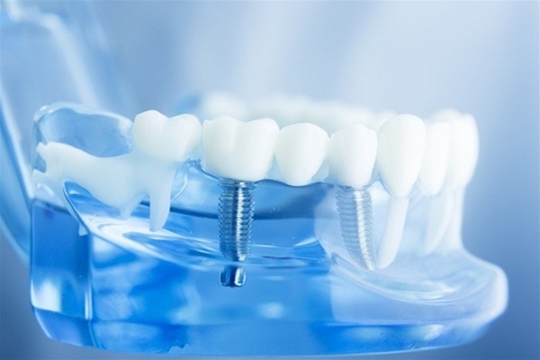 Chuyên gia lưu ý những yếu tố trước và sau khi cấy ghép Implant