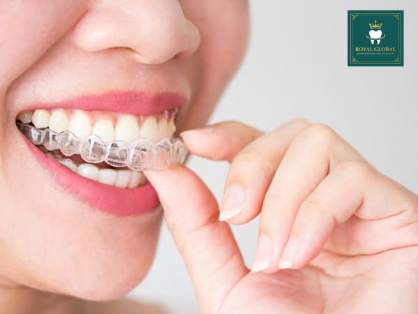 Giải Mã Toàn Tập Về Niềng Răng: Độ Tuổi Lý Tưởng, Chi Phí & Hiệu Quả Vĩnh Viễn