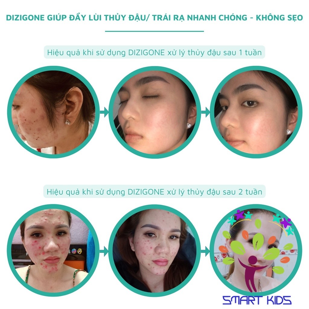 Kem Bôi Da Dizigone Nano Bạc - Kháng Khuẩn, Lành Vết Thương, Tái Tạo Da, Ngăn Ngừa Sẹo 25g