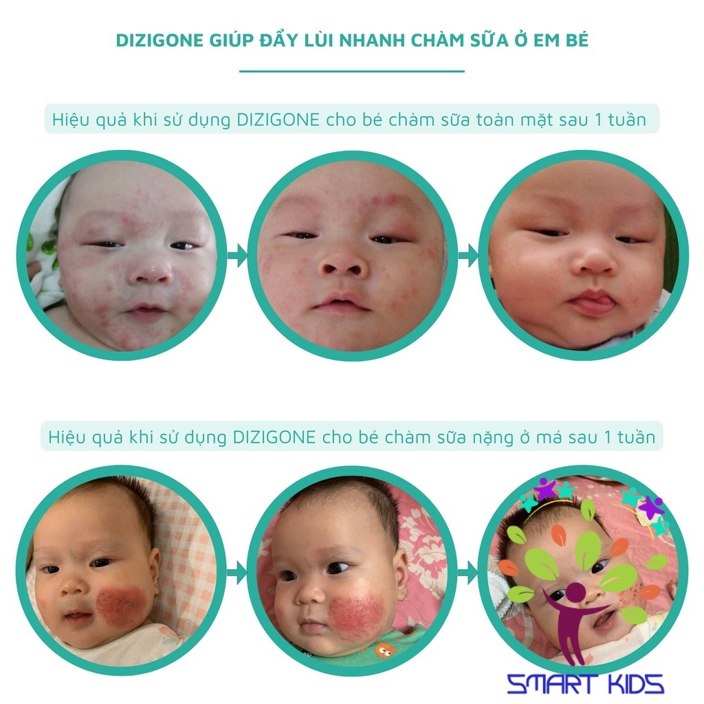 Kem Dizigone Baby Dịu Mẩn Ngứa, Ngừa Hăm Da, Bảo Vệ Và Phục Hồi Da Bé Tuýp 30g