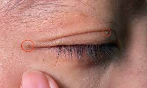Lesser nốt ruồi mụn thịt