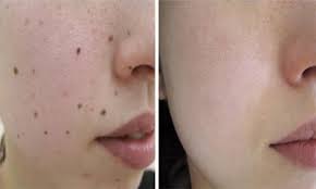 Lesser nốt ruồi mụn thịt