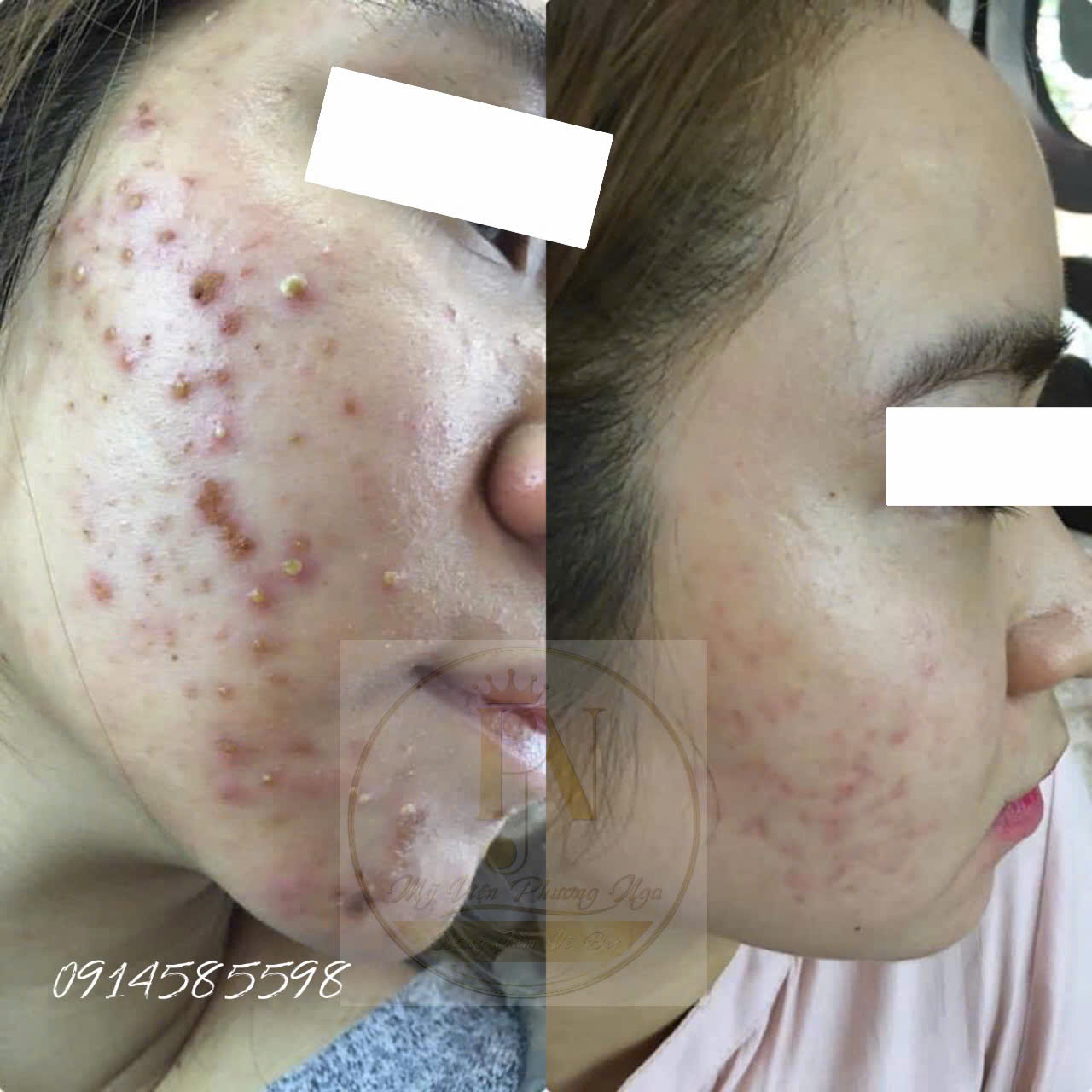 Điều trị da mụn cơ bản