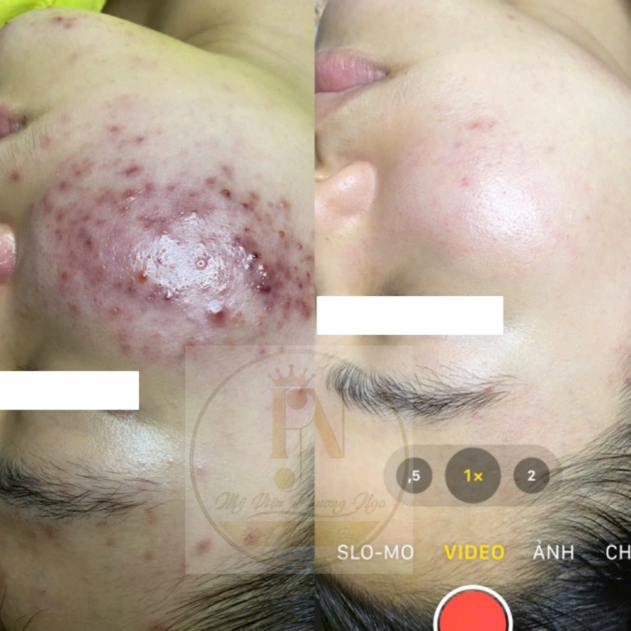 Điều trị mụn chuyên sâu