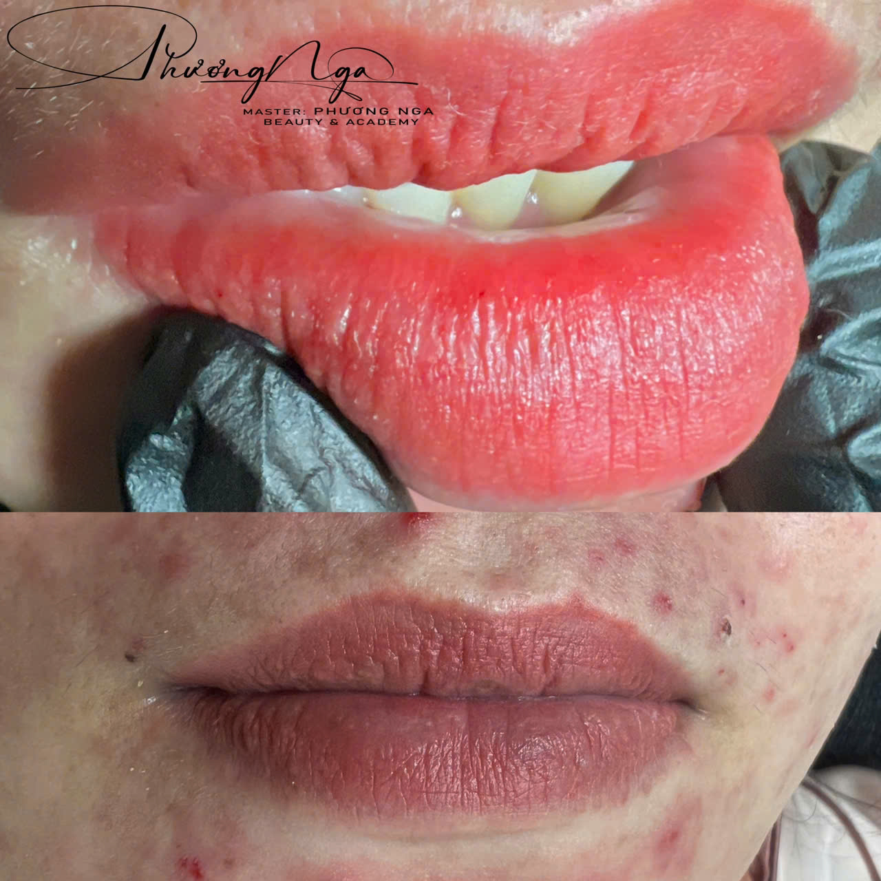 Khử thâm môi kết hợp ủ dưỡng (Detox + Collagen)