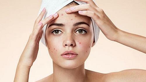 NHỮNG LƯU Ý CHĂM SÓC DA MỤN BẠN CẦN BIẾT