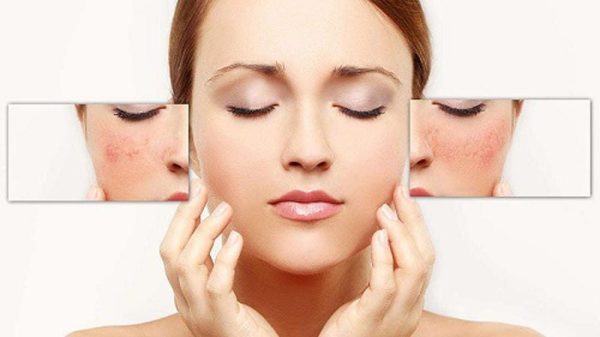 BÍ QUYẾT PHỤC HỒI DA NHIỄM CORTICOID