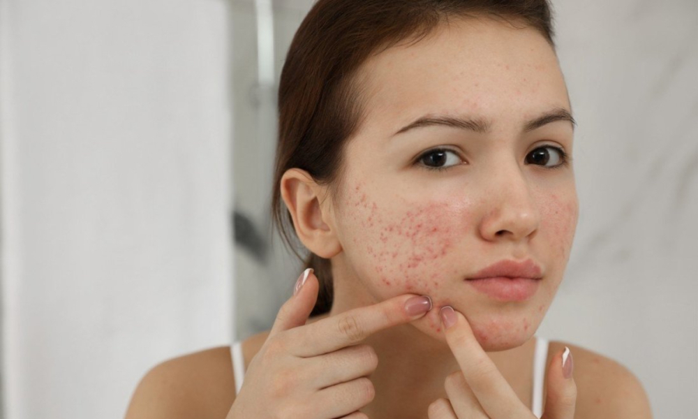 Trang điểm thế nào khi làn da nổi mụn?