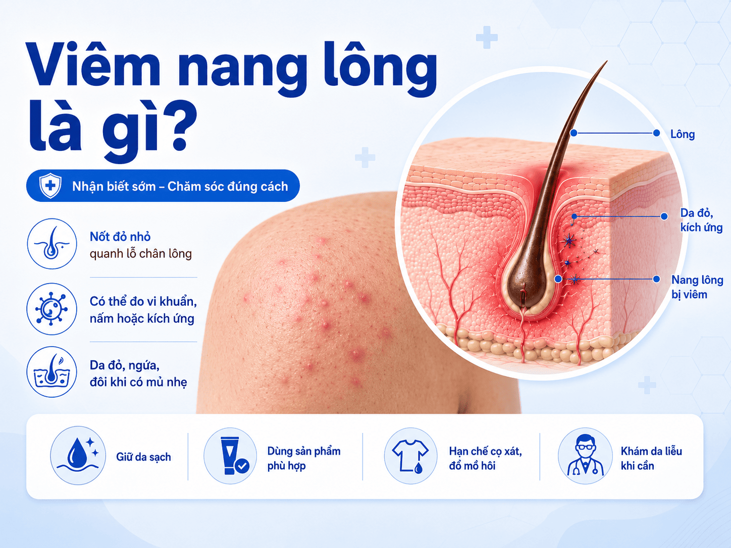 Viêm nang lông là gì? Nguyên nhân bị viêm nang lông mùa  Tết 