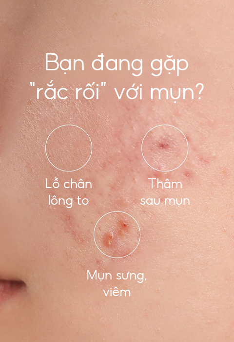 Giảm mụn chuyên sâu