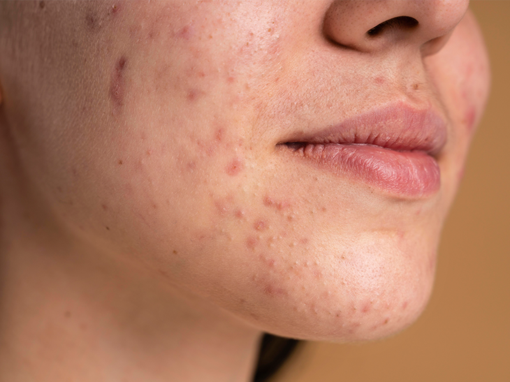 DỊ ỨNG MỸ PHẨM LÀ GÌ? CÁCH XỬ LÝ VÀ PHÒNG TRÁNH HIỆU QUẢ