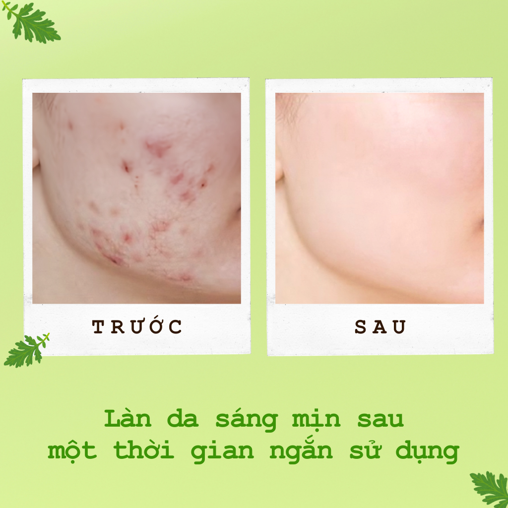 Mặt Nạ Ngủ Ngải Cứu Ngừa Mụn Sáng Da