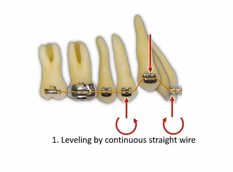 High Canine Teeth: Analysis of Retraction Methods