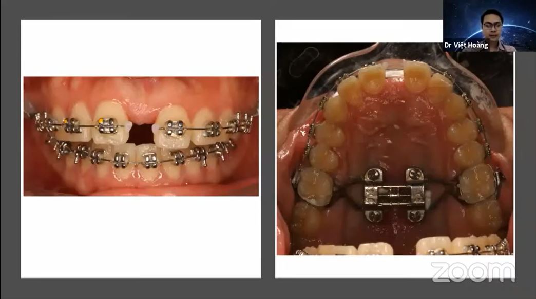 The power of 3D simulation in diagnostic and orthodontics treatment Dr Việt Hoàng