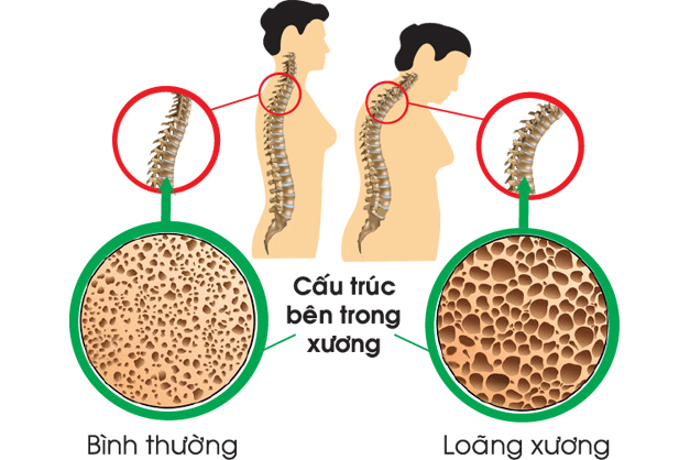 Dấu hiệu của bệnh loãng xương