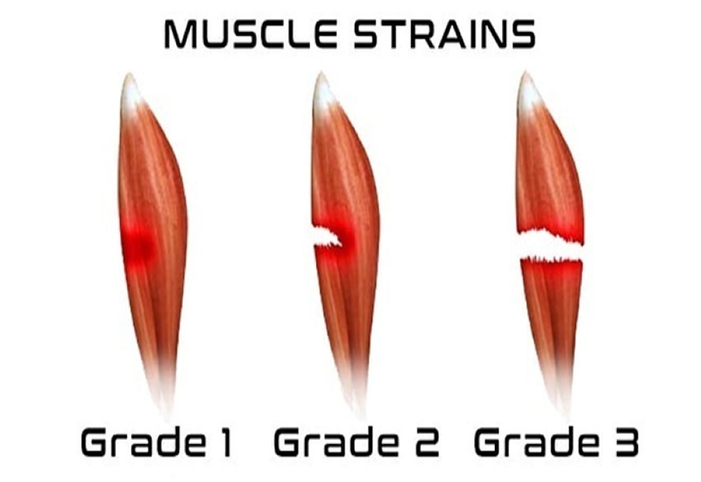 3 mức độ căng cơ