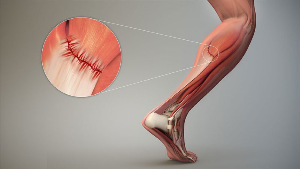 Căng cơ (muscle strain)