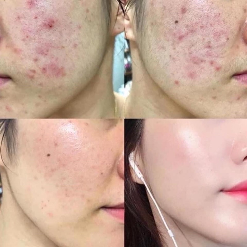 [FREE SHIP] Serum The Ordinary Mờ Thâm Mụn Sáng Da NIACINAMIDE 10% + Zinc