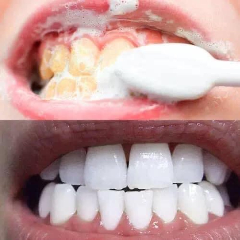 Kem Đánh Trắng Răng MEDIAN Hàn Quốc