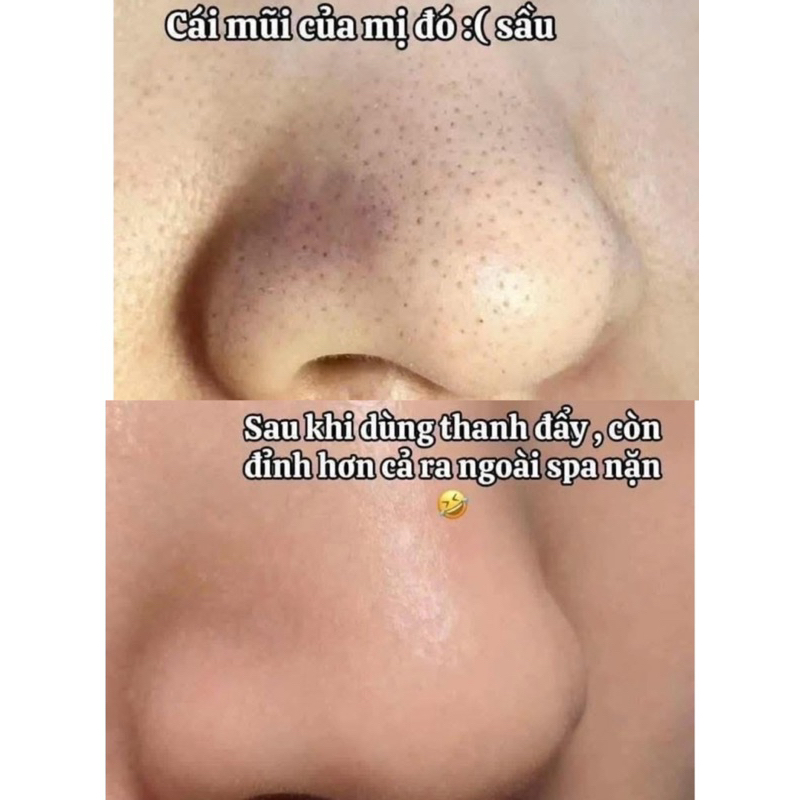 [ILSO] Cây Nặn Mụn Đầu Đen ILSO chuyên dụng Deep Clean Master giúp đẩy & lấy mụn đầu đen dễ dàng
