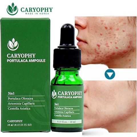 Serum Tinh Chất Caryophy Giảm Mụn Mờ Thâm Se Lỗ Chân Lông 30ml - [Mẫu Mới]
