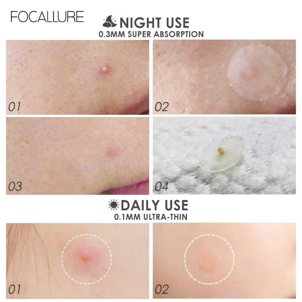 [FOCALLURE] Miếng Dán Mụn FOCALLURE Siêu Mỏng Trong Suốt Không Thấm Nước, Hỗ Trợ Giảm Sưng Viêm 24 miếng (FA186)