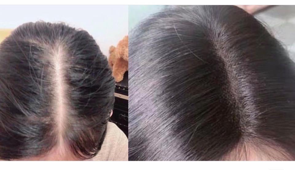 Tóc Giả Phủ Hói Phủ Bạc Đỉnh Đầu Không Mái 4D Cao Cấp – Mái Che Đỉnh Tự Nhiên, Tơ Mềm Như Tóc Thật, Kẹp Chắc Không Lộ