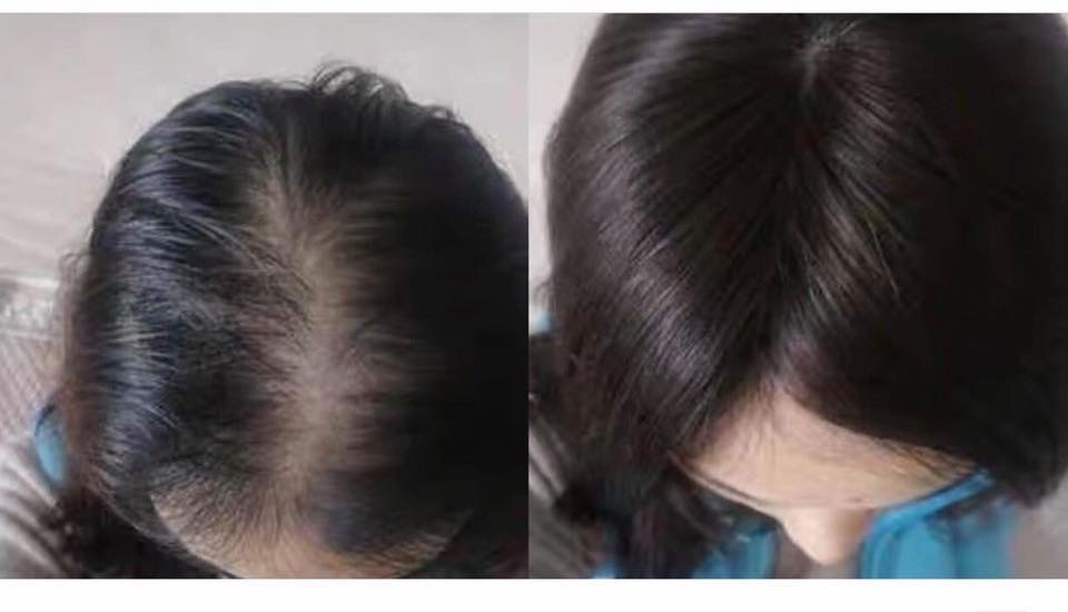 Tóc Giả Phủ Hói Phủ Bạc Đỉnh Đầu Không Mái 4D Cao Cấp – Mái Che Đỉnh Tự Nhiên, Tơ Mềm Như Tóc Thật, Kẹp Chắc Không Lộ