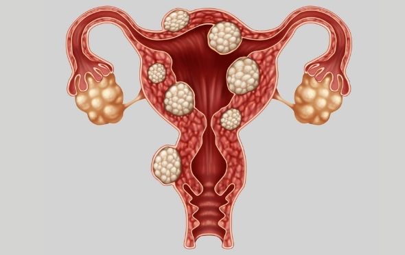 4 Dấu Hiệu Cho Thấy Chị Em Có Nguy Cơ Mắc Lạc Nội Mạc Tử Cung Mà Tuyệt Đối Không Nên Bỏ Qua