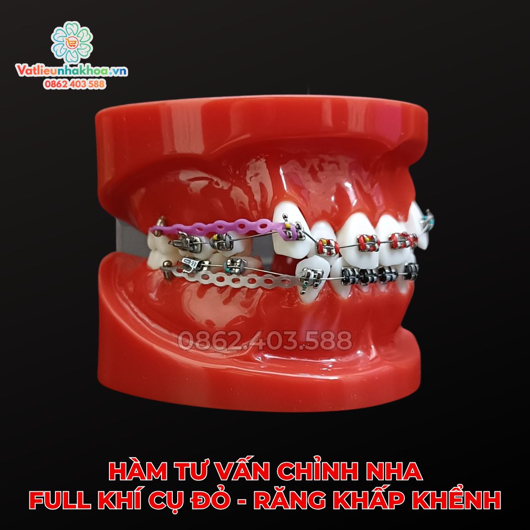 Hàm tư vấn chỉnh nha full khí cụ đỏ - Răng khấp khểnh