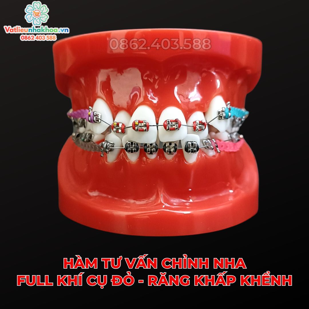 Hàm tư vấn chỉnh nha full khí cụ đỏ - Răng khấp khểnh