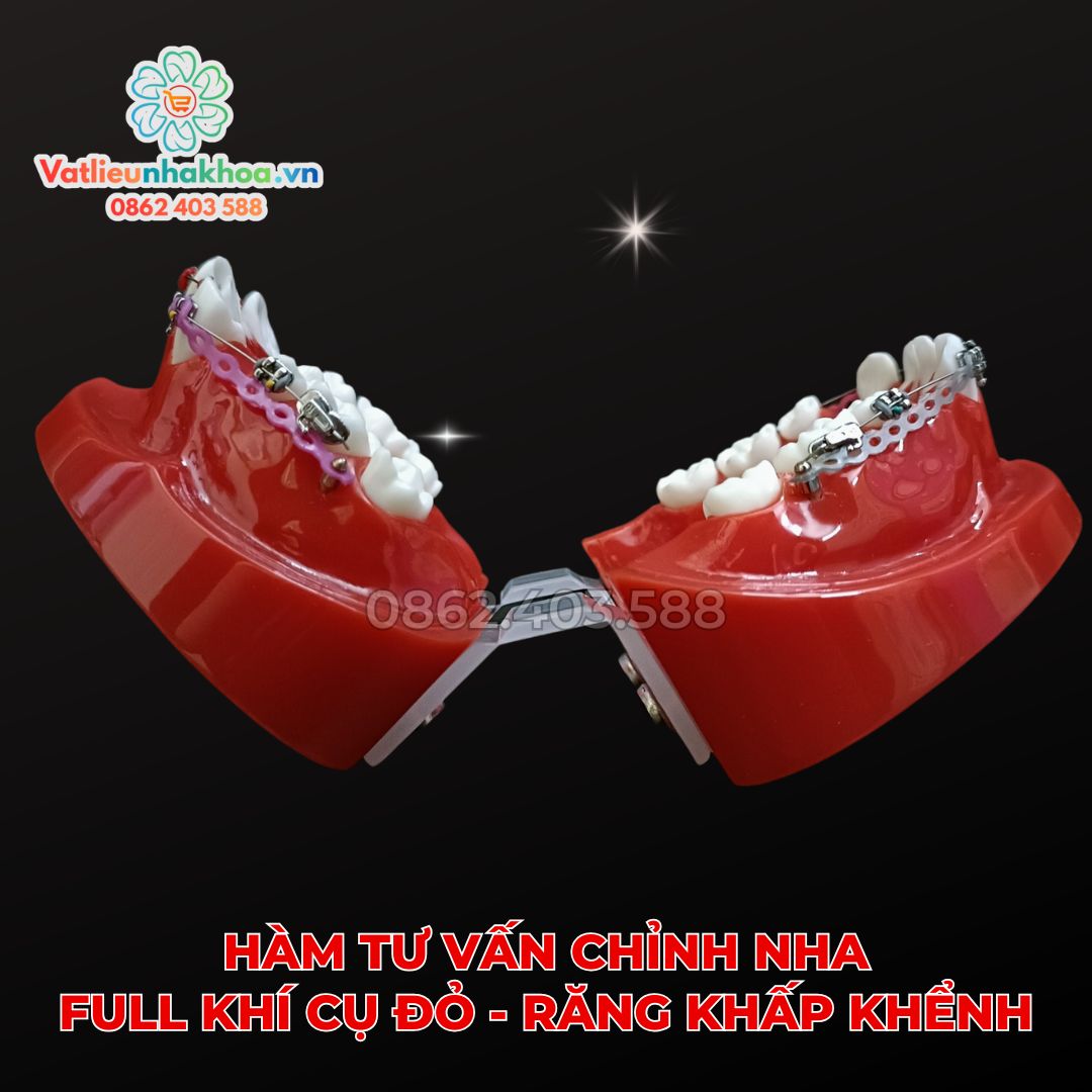 Hàm tư vấn chỉnh nha full khí cụ đỏ - Răng khấp khểnh