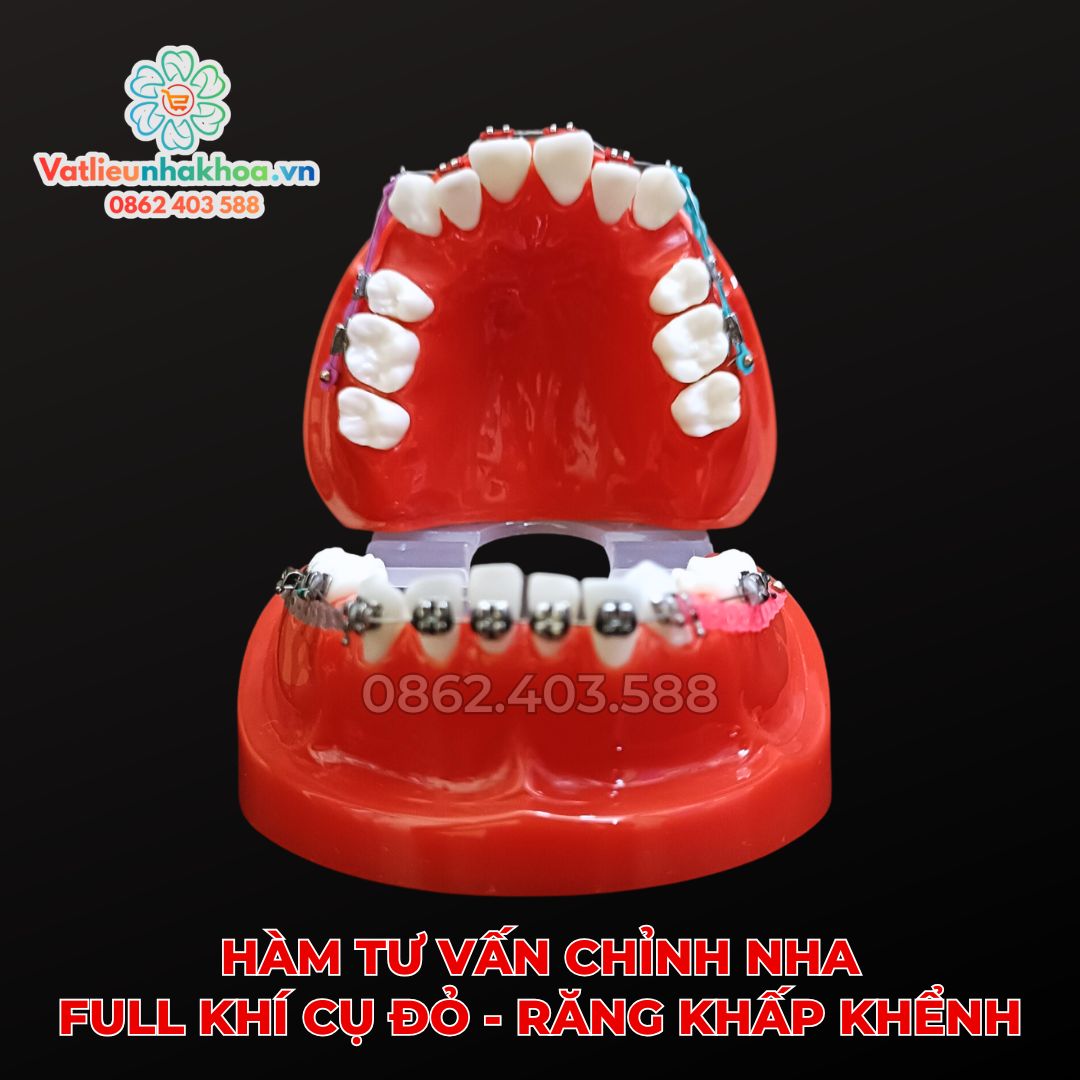 Hàm tư vấn chỉnh nha full khí cụ đỏ - Răng khấp khểnh