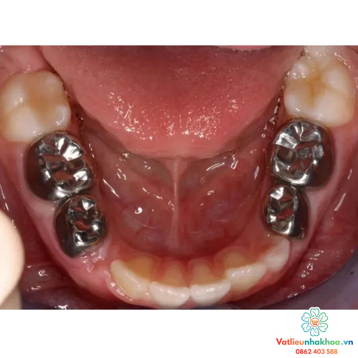 Chụp thép trẻ em 3M (Hộp 2 chiếc)