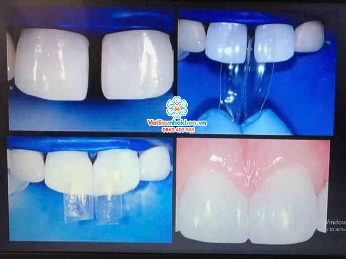 Bộ matrix hàn tam giác đen và khe thưa (matric)