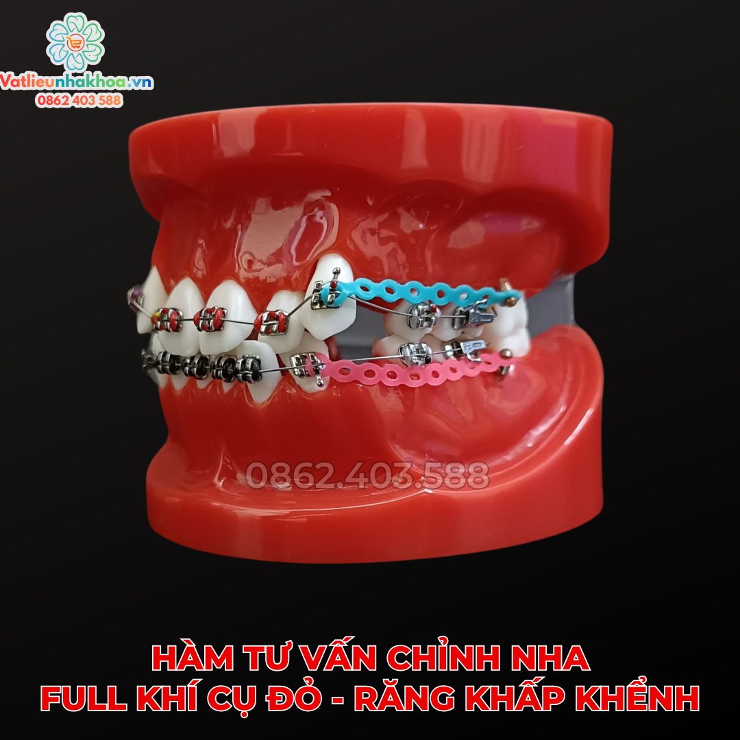 Hàm tư vấn chỉnh nha full khí cụ đỏ - Răng khấp khểnh