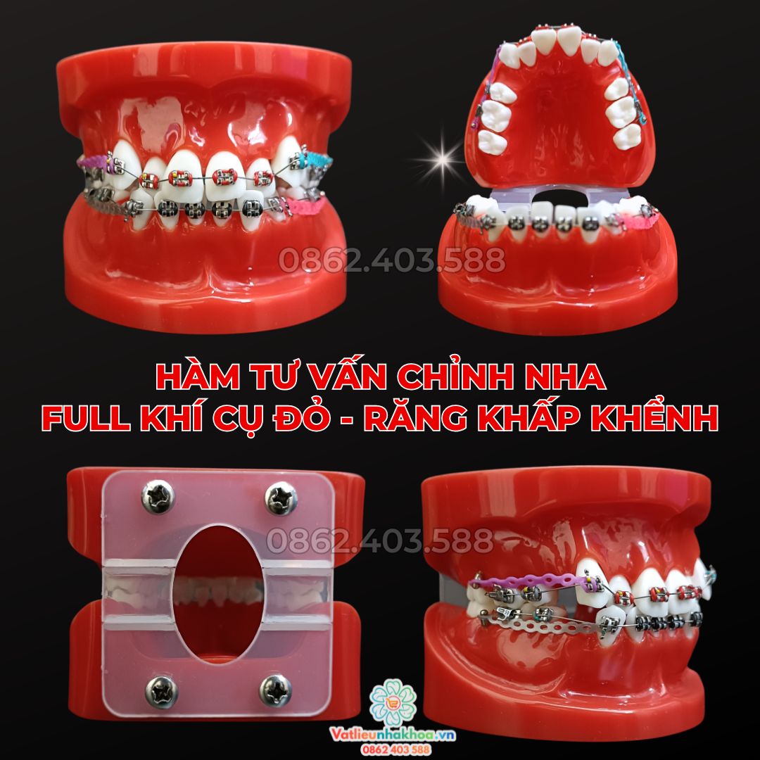 Hàm tư vấn chỉnh nha full khí cụ đỏ - Răng khấp khểnh