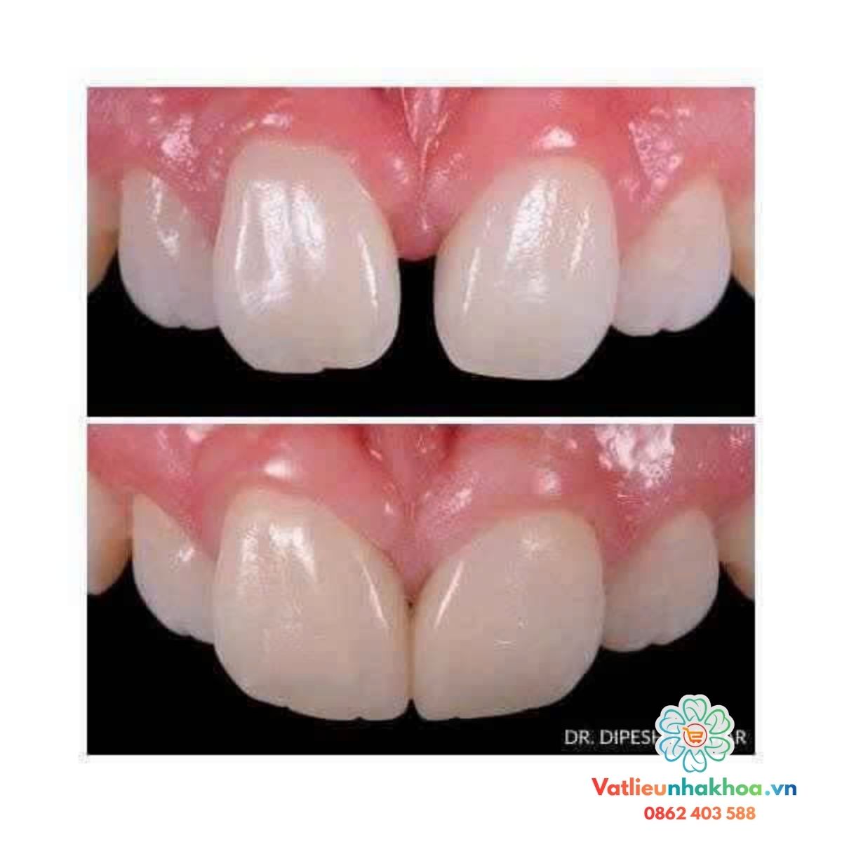 Bộ matrix hàn tam giác đen và khe thưa (matric)