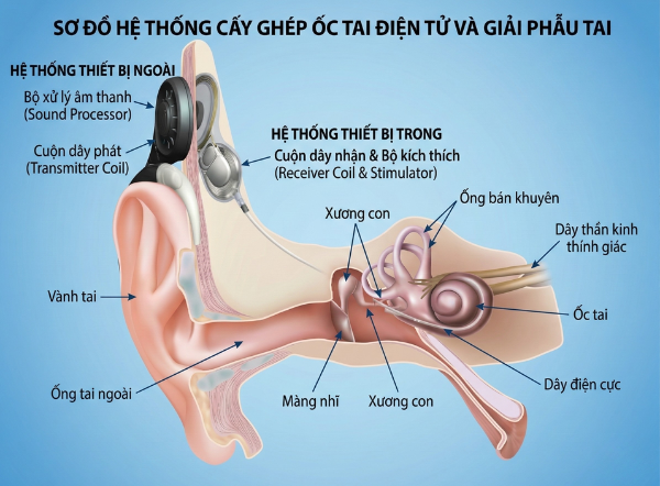 Sơ đồ hệ thống cấy ghép ốc tai điện tử và giải phẫu tai