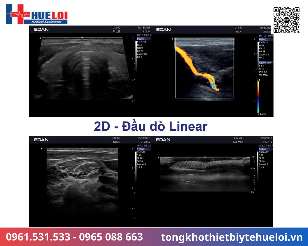chất lượng hình ảnh siêu âm