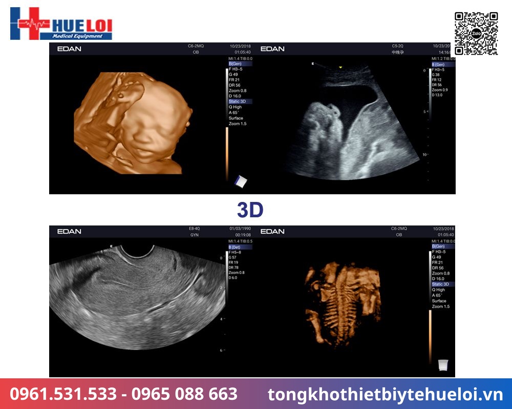chất lượng hình ảnh siêu âm