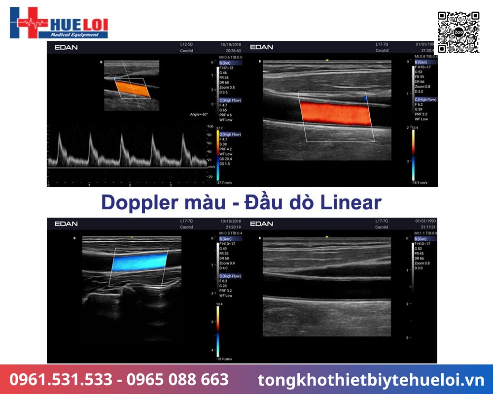 chất lượng hình ảnh siêu âm