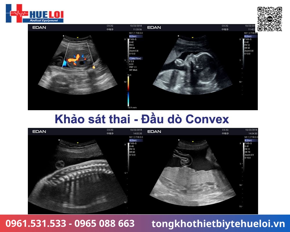 chất lượng hình ảnh siêu âm