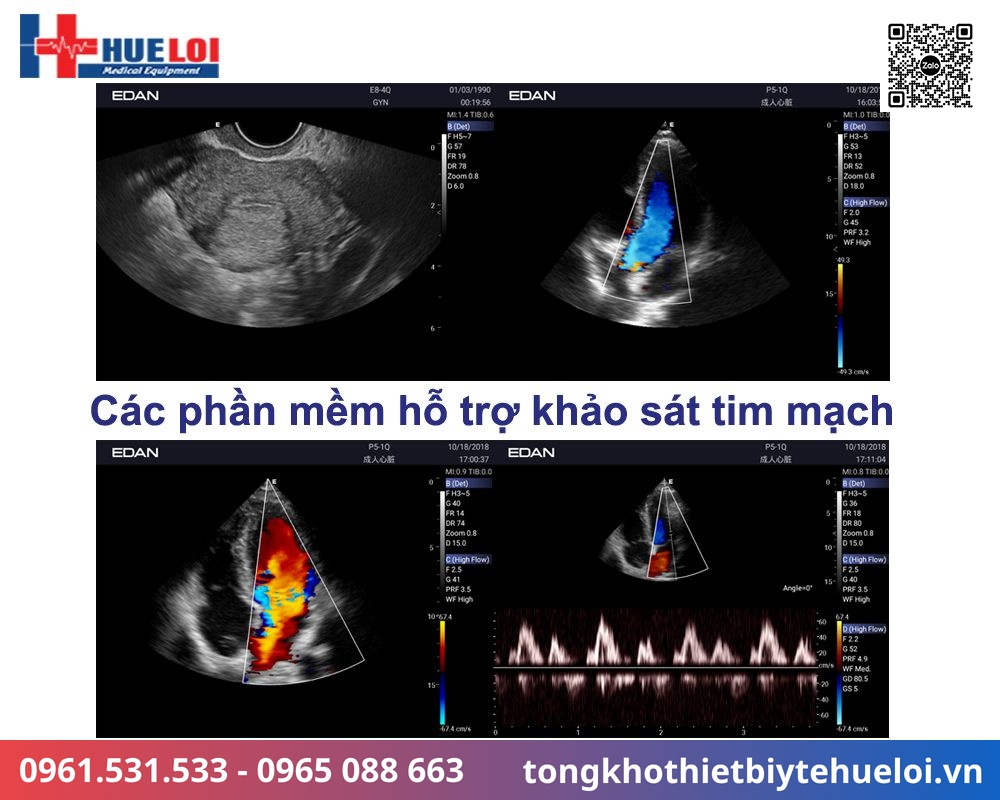 chất lượng hình ảnh siêu âm
