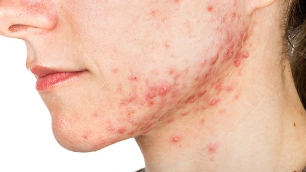 Kích Ứng Hay Đẩy Mụn? Hiểu Đúng Để Tự Cứu Làn da