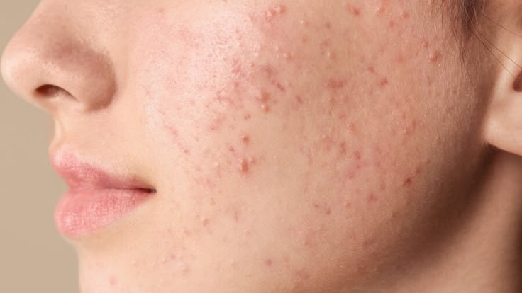 Mụn ẩn dùng gì? Có khi bạn đang điều trị sai ngay từ đầu